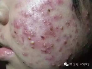 茄子螨虫的危害与防治小秘诀