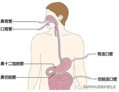 急性猪肺疫治疗中，如何根据症状选择最佳药物和预防策略？
