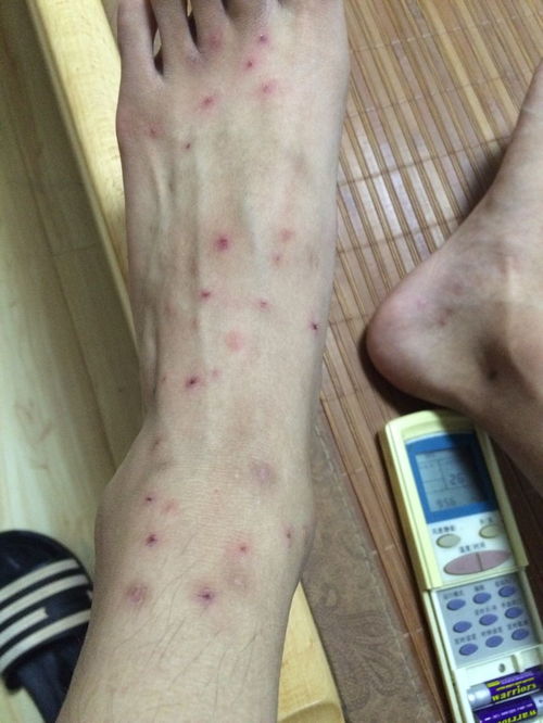 臭虫怎么杀？特效药快速见效方法