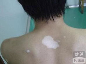 梭子蟹常见疾病如烂肢病、白斑病等