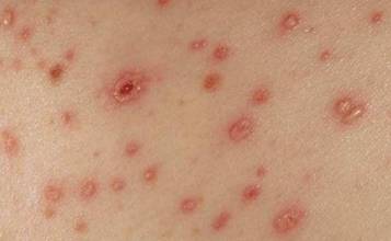 草莓灰霉病初期症状大揭秘