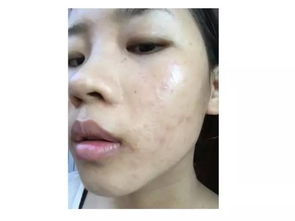 还有，一些民间偏方也彳艮有用哦