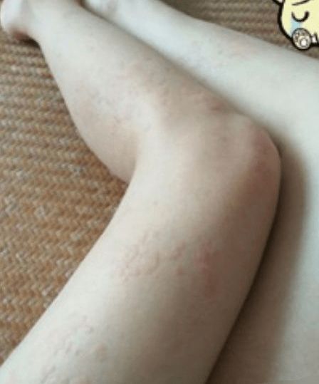 菊花痒是什么原因造成的？如何快速止痒
