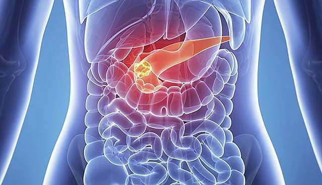 胰腺癌与农药的神秘关联