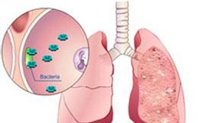 腺肌胃炎解析：症状、成因及防控要点
