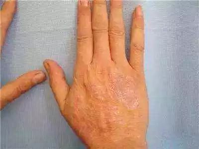 甲霜灵的适用范围