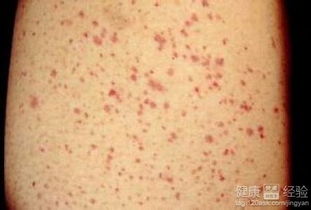 高氯甲维盐接触皮肤过敏的原因