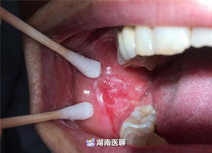 口腔溃疡的成因多种多样，百菌清能治本吗？