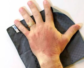 案例分享：农药中毒的紧急处理