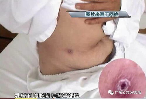 甲维虫酰肼中毒后急救措施揭秘