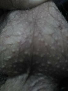 晚上菊花痒，是过敏还是寄生虫在作怪