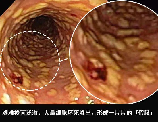 蓝孔雀球虫与魏氏梭菌混合感染，引发腹泻、消瘦