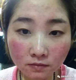 是过敏反应还是汗斑症状？