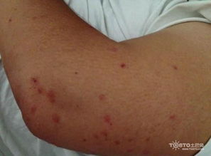 如何防范过敏？