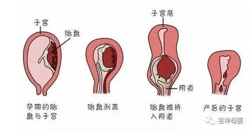 产程长恶露排不净，如何预防子宫炎发生？