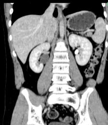 症状二：椭圆形斑点， 边缘淡褐色