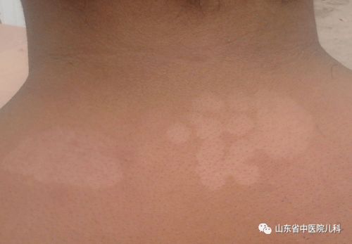 喷了汗斑济一身红，是啥意思呀？