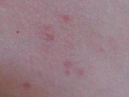 猪皮肤紫癜的病理和病因是什么引起的？