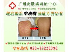 银屑病的反复发作