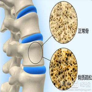 鹌鹑骨质疏松病是鹌鹑骨骼脆弱、易骨折的代谢性疾病