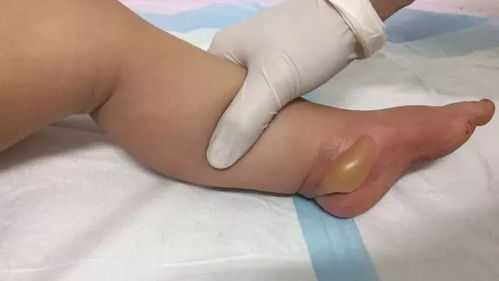 高温灼伤明显症状