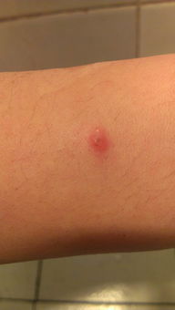 什么农药Neng杀灭痘痘和痘痘虫？