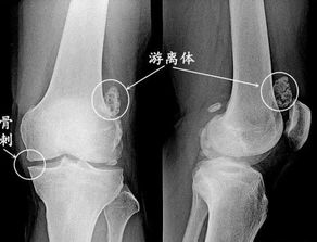 菊花起肉疙瘩怎么办？试试中医外敷疗法