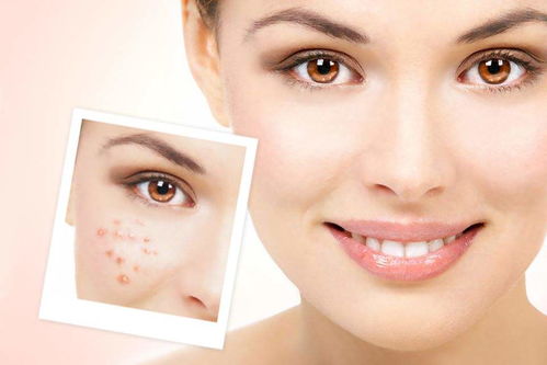 治疗脸上黄褐斑