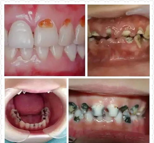 嚼槟榔危害大，牙齿脱落怎么办