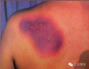 烟草黑斑肆虐，己唑醇Neng否科学用药亩降损1200元？