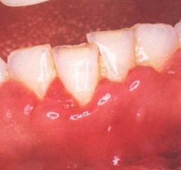 牙龈出血，甲硝唑片怎么用？