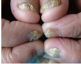 灰指甲，你到底有多烦人？