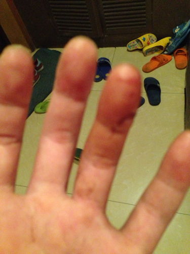 手指伤口沾到除草剂后的严重后果：揭秘与应对