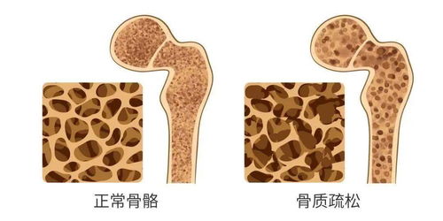 孕期补钙，关注母体和胎儿骨骼健康