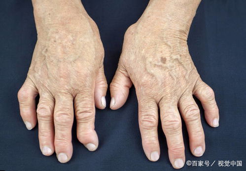 类风湿疼得受不了？接骨木偏方靠谱吗
