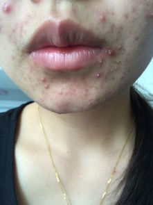 4. 脸上起红疙瘩， 痒痒的