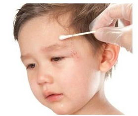 2. 清洗消毒， 刻不容缓