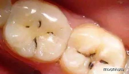 牙齿健康的秘密武器：这些食物你吃了吗？