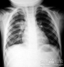 伪狂犬病毒与胸膜肺炎放线杆菌混合感染