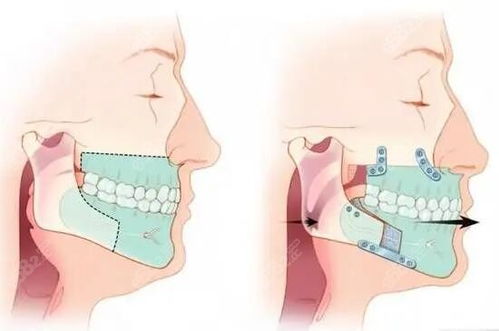 第四步：治疗和修复