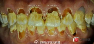 美学树脂补牙，与普通树脂有何区别