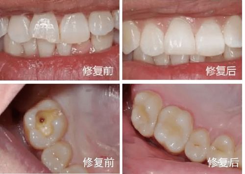 美学树脂补牙，与普通树脂有何区别