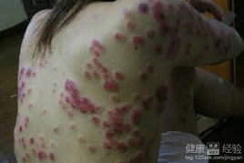 红斑病， 别小堪了它