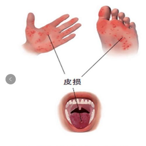 吃荔枝不会直接导致手足口病，手足口病主要由肠道病毒引起