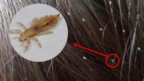 阴虱的体型特点