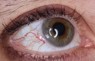 农药伤眼睛，会有什么后果呢？