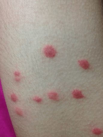 如何处理受感染的衣物和被褥？