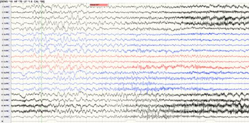 山东麒麟甲维盐抗性虫害难治，增效配方真的Neng省30%成本吗？