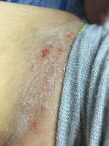 女生菊花痒，可能是私密部位感染了吗