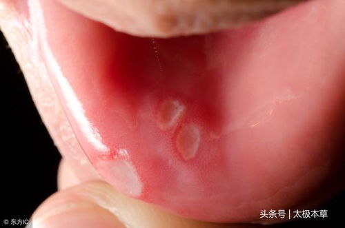 茶油助力口腔溃疡快速愈合：天然疗法揭秘